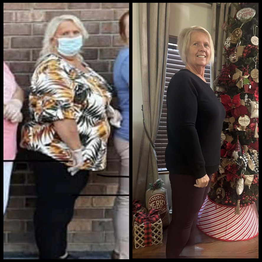 Before and after significant weight-loss transformation